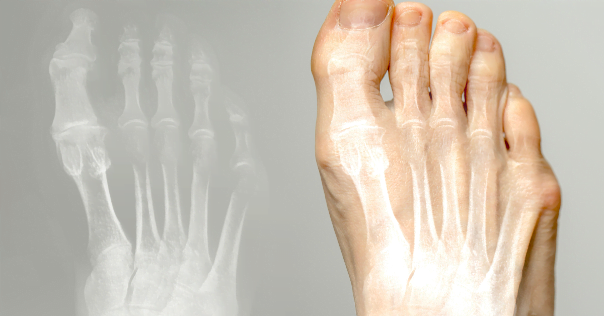 Hallux valgus behandeling – teenspreider en schoeisel