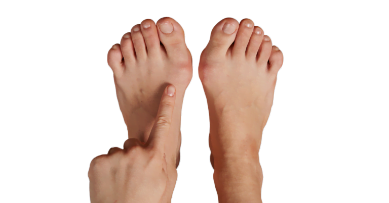 Hallux-valgus-1200x628-1