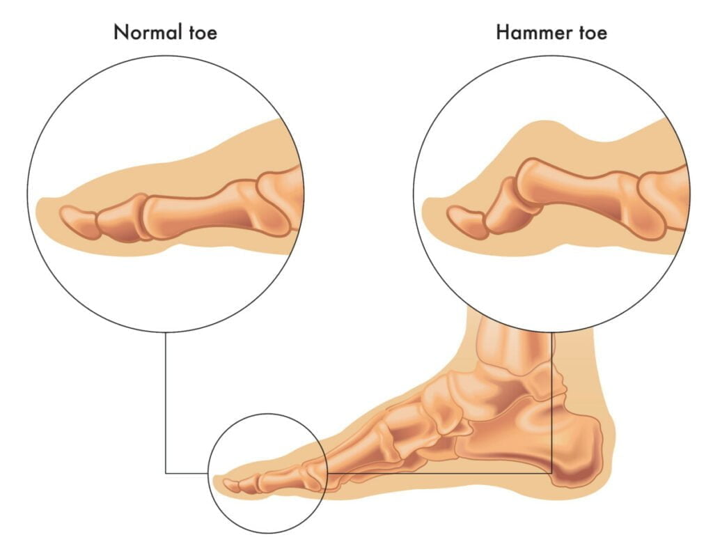 Difference between normal toe and hammertoe