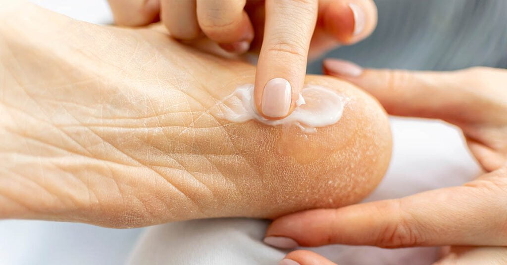 Appliquer de la crème sur les talons crevassés